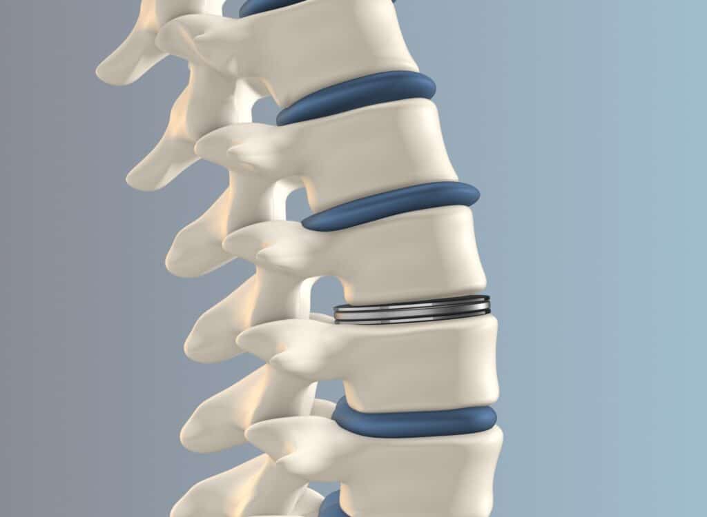 Metal spine implant